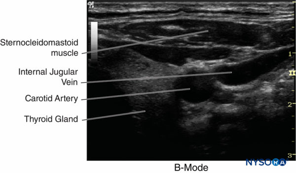 Physics Of Ultrasound - NYSORA