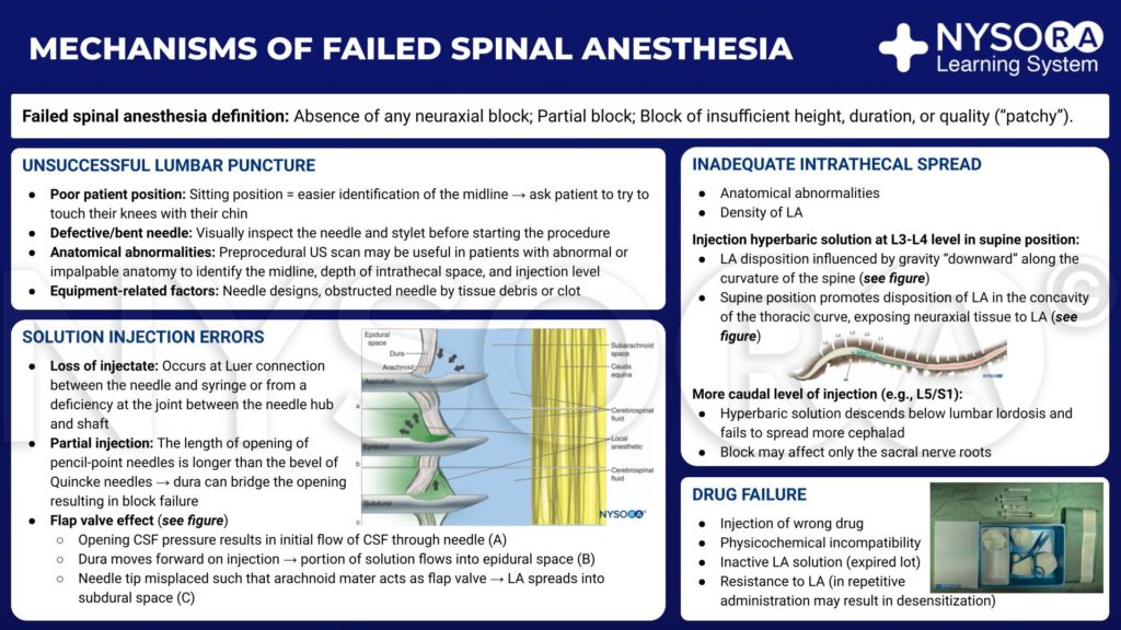 regional-anesthesia-mechanism-of-failed-spinal-anesthesia-infographic