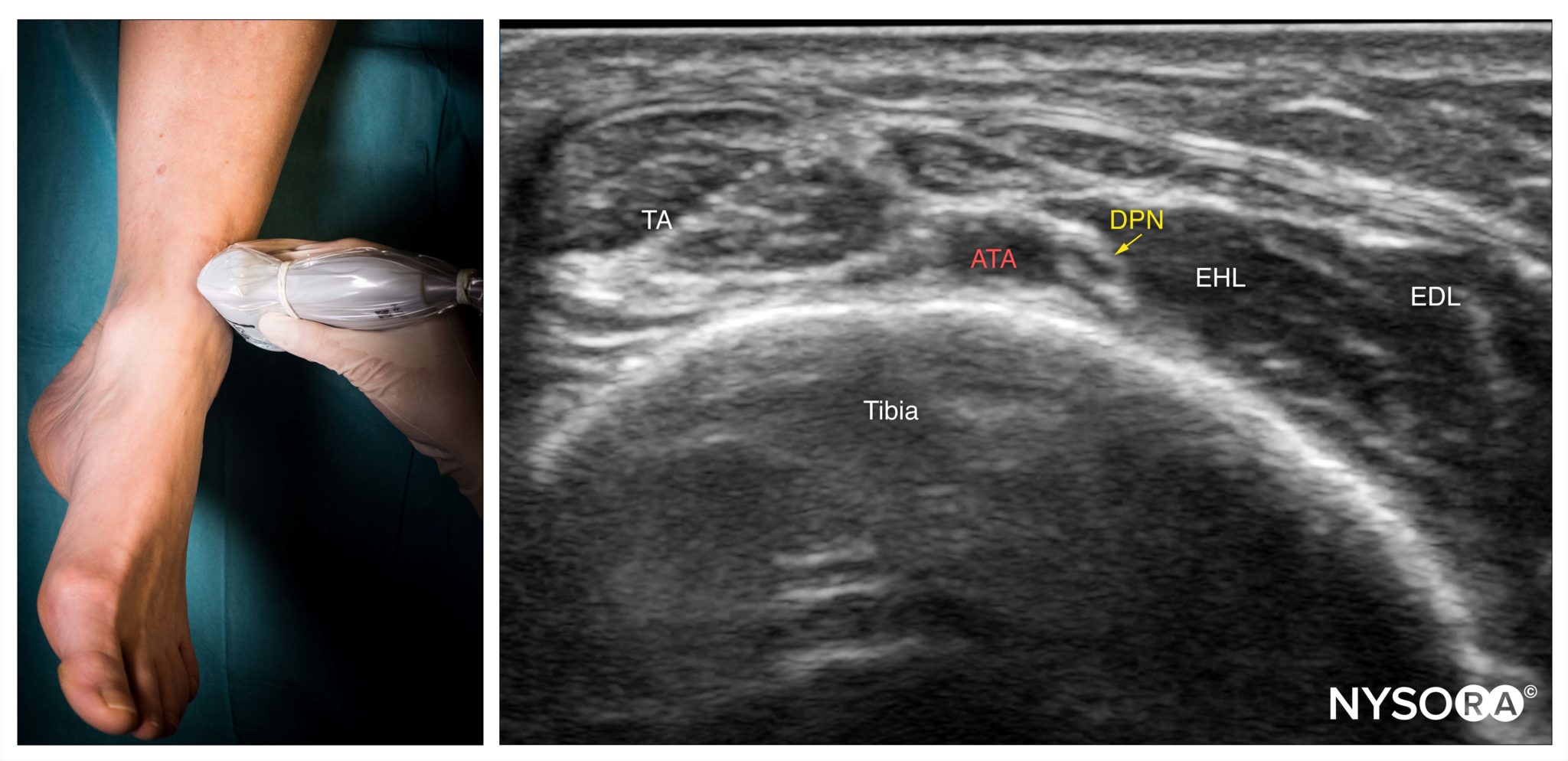 le-ankle-deep-peroneal-probe-us-nysora