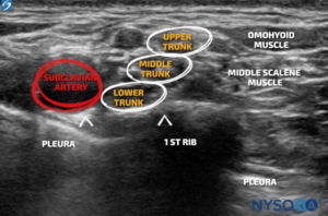 subclavian artery lower trunk middle scalene muscle - NYSORA