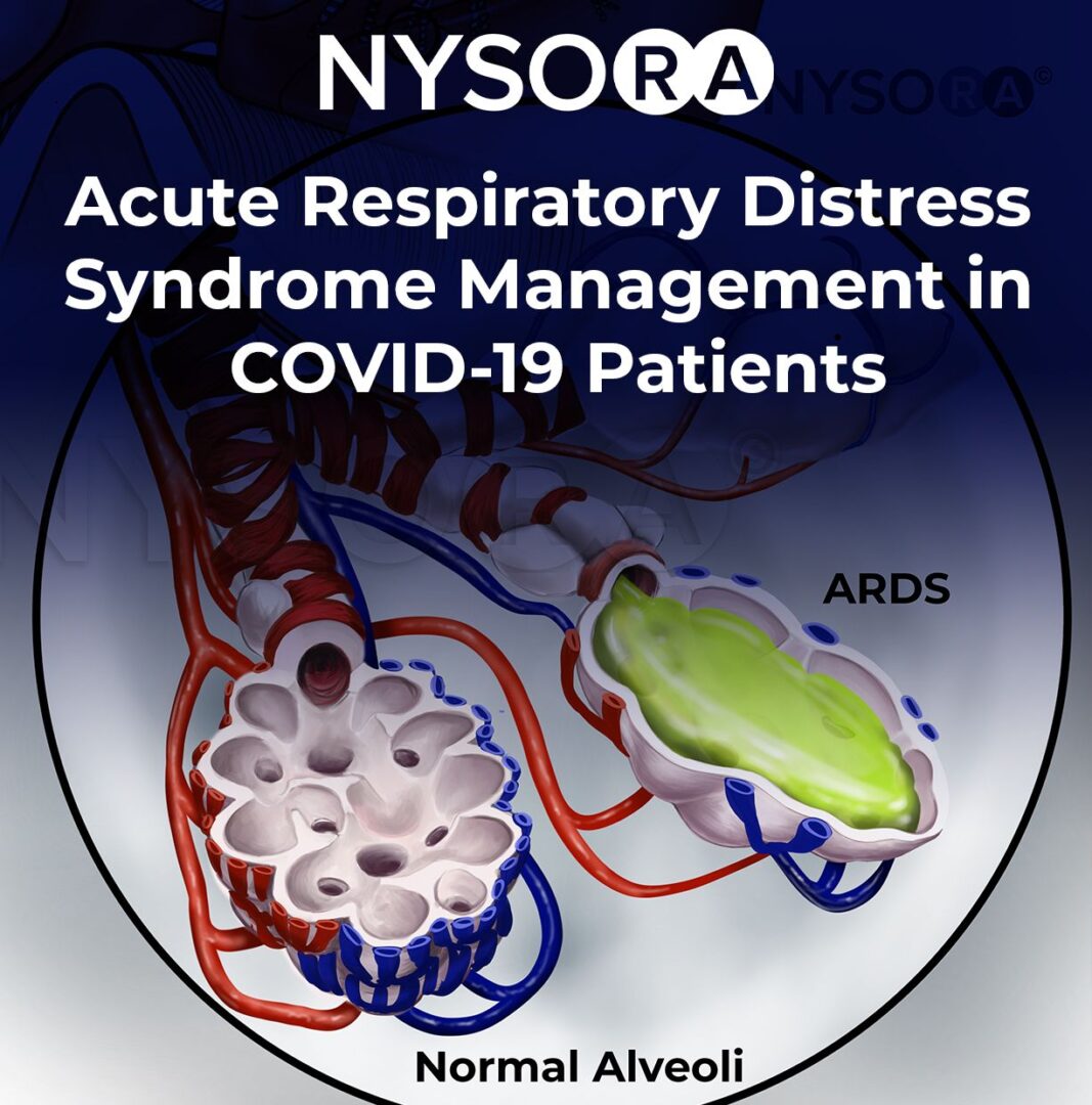 Acute Respiratory Distress Syndrome Management In COVID-19 Patients ...