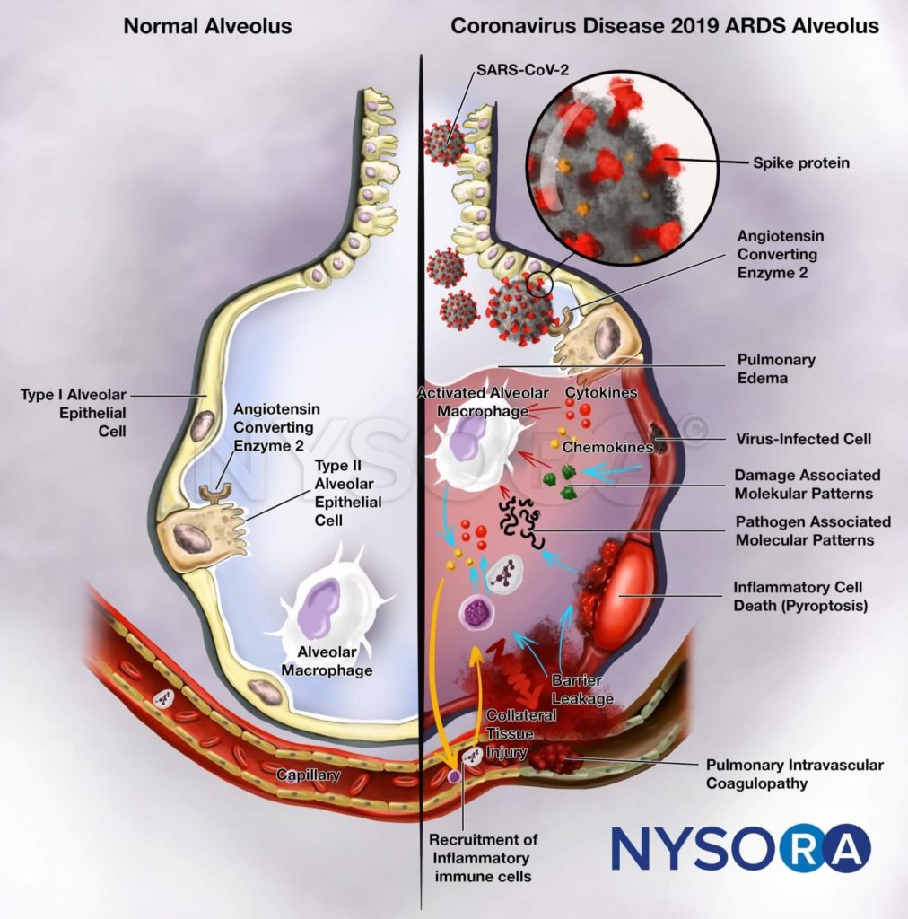 Acute Respiratory Distress Syndrome Management In Covid Patients Nysora