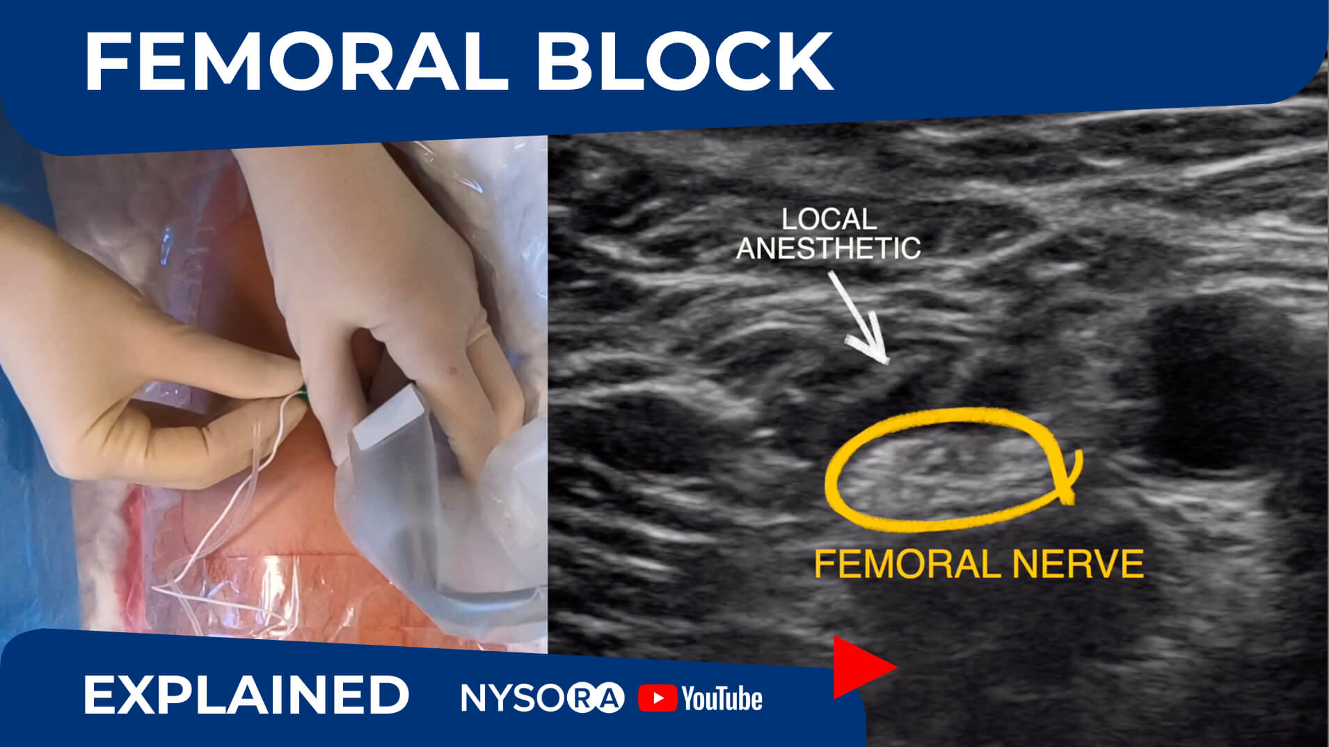 Ultrasound Guided Femoral Nerve Block Regional Anesthesia Crash Course With Dr Hadzic Nysora