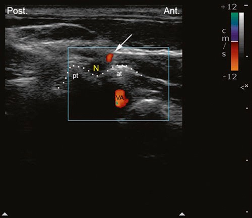 Atlas of Ultrasound-Guided Procedures in Interventional Pain Management ...