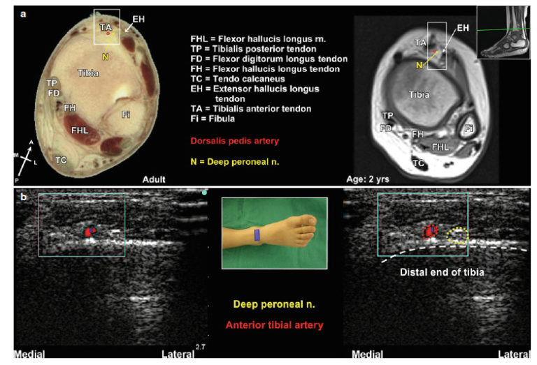 Pediatric Atlas Of Ultrasound And Nerve Stimulation Guided Regional