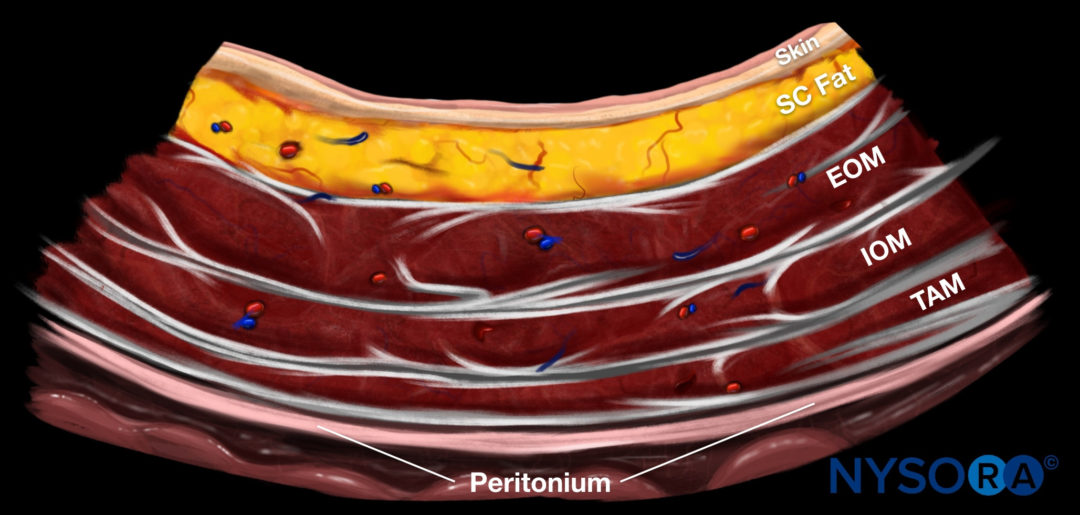 Ultrasound-Guided Transversus Abdominis Plane (TAP) Block - NYSORA