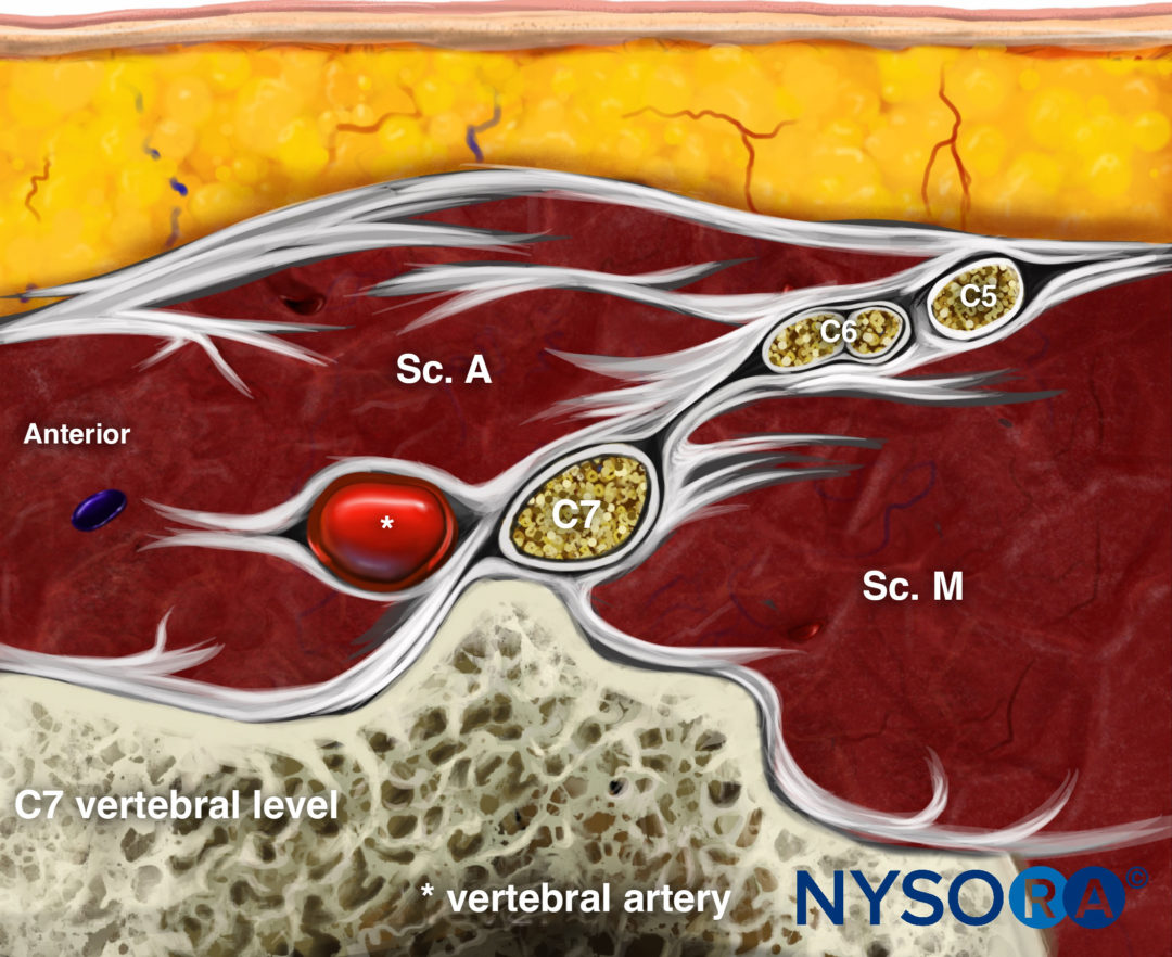 Ultrasound-Guided Upper Extremity Blocks - NYSORA