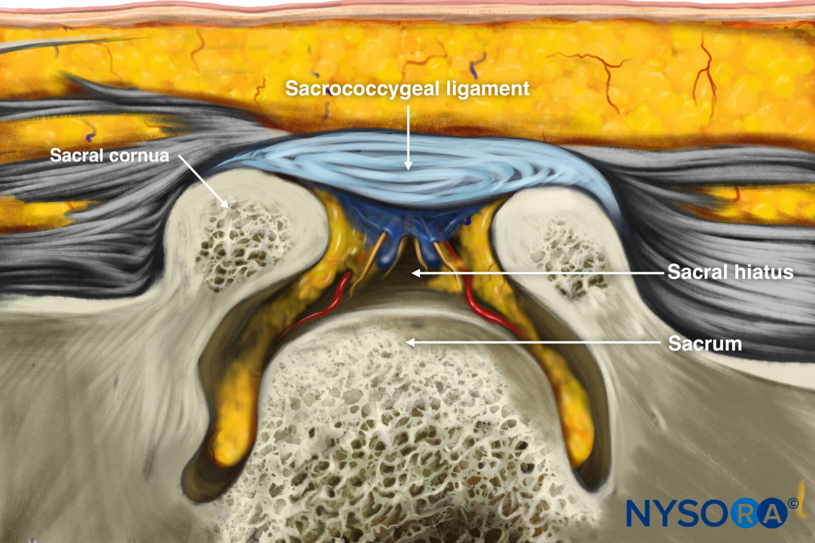 7._Fig_9._Caudal_Epidural_Injection copy - NYSORA