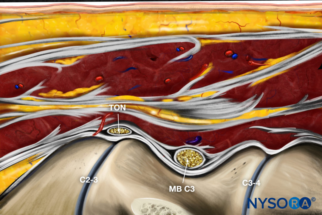 Ultrasound-Guided Third Occipital Nerve and Cervical Medial Branch ...