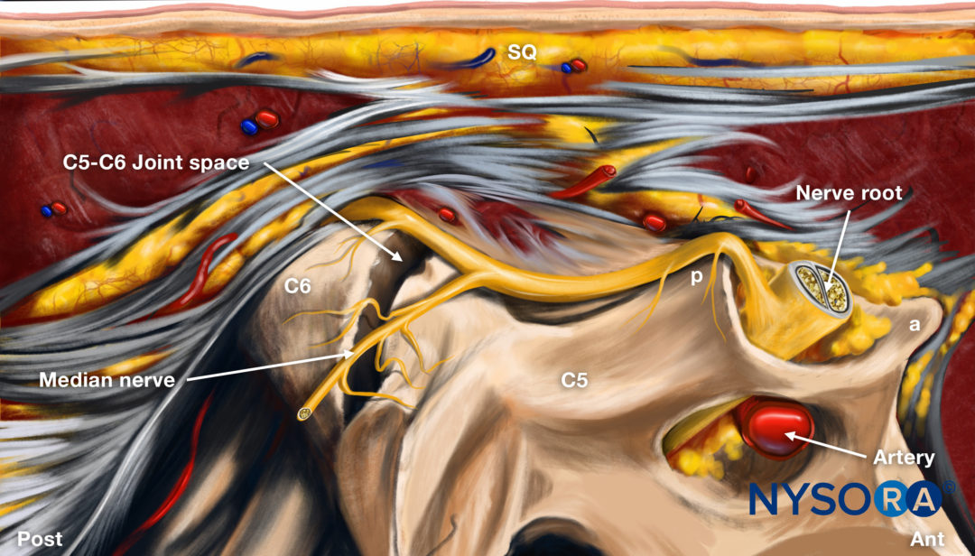 Ultrasound-Guided Cervical Zygapophyseal (Facet) Intra-Articular ...