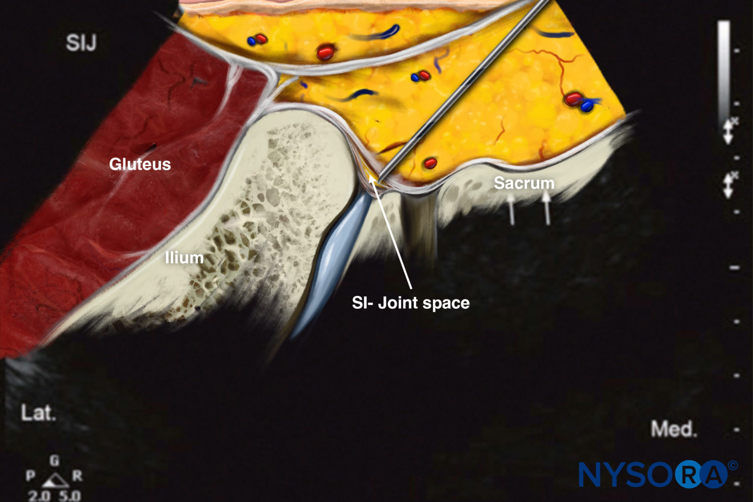 Ultrasound Guided Sacroiliac Joint Injection Nysora 7884