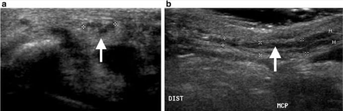 Ultrasonography of Peripheral Nerves - NYSORA