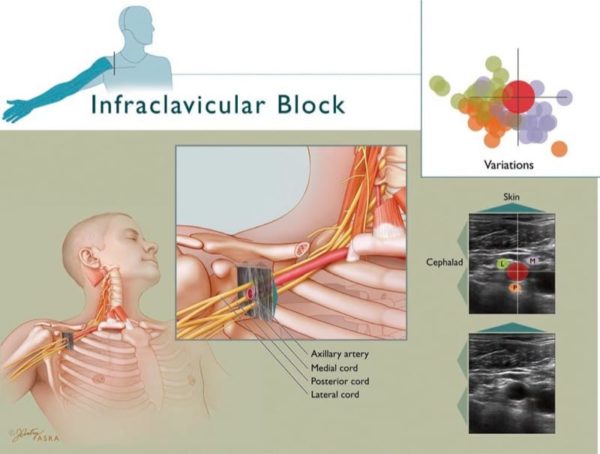 Bloqueos De La Extremidad Superior Guiados Por Ultrasonido - NYSORA