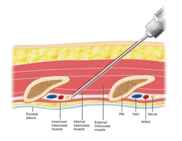 Ultrasound-Guided Peripheral Nerve block in Chronic Pain Management ...