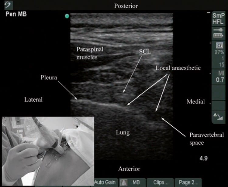 Bloc paravertébral thoracique guidé par ultrasons - NYSORA