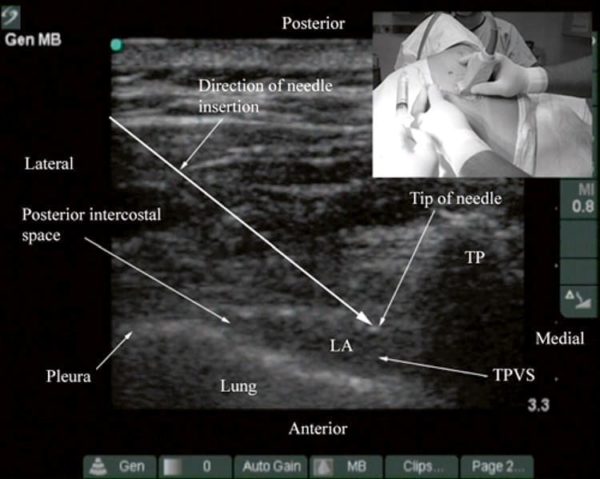 Ultrasound-Guided Thoracic Paravertebral Block - NYSORA