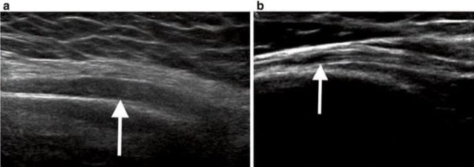 Ultrasonography of Peripheral Nerves - NYSORA