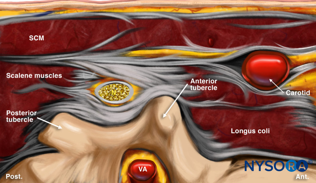 Ultrasound-Guided Cervical Nerve Root Block - NYSORA