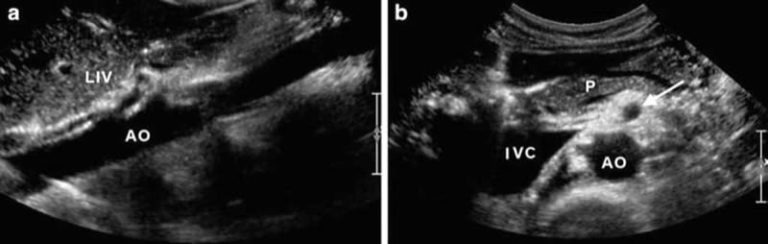 Ultrasound Guided Celiac Plexus Block And Neurolysis Nysora