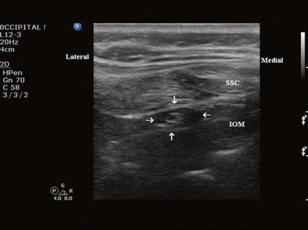 Occipital Neuralgia: Sonoanatomy and Sonopathology of the Occipital ...