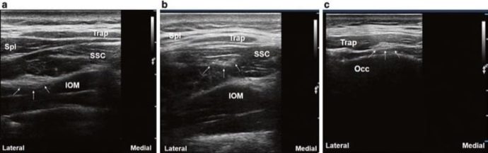 Occipital Neuralgia: Sonoanatomy and Sonopathology of the Occipital ...