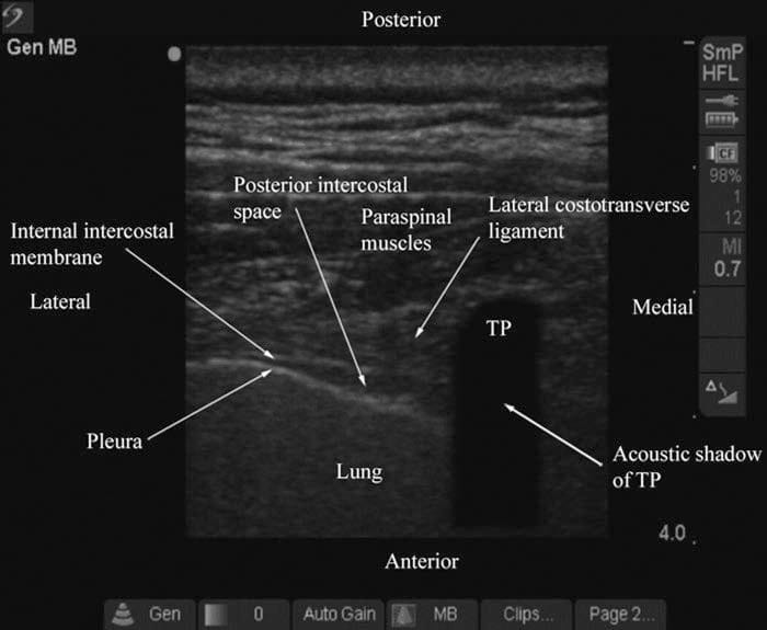 Bloc paravertébral thoracique guidé par ultrasons - NYSORA