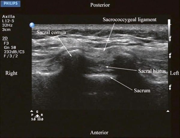 Ultrasound-Guided Central Neuraxial Blocks - NYSORA