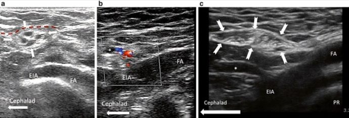 Ultrasound-Guided Blocks for Pelvic Pain - NYSORA