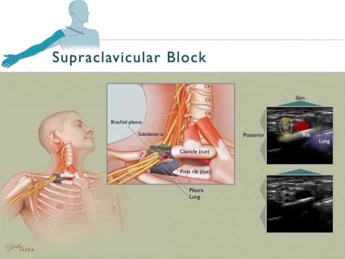 Ultrasound-Guided Upper Extremity Blocks - NYSORA