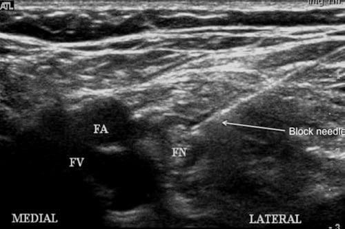 Blocs nerveux du membre inférieur guidés par ultrasons - NYSORA