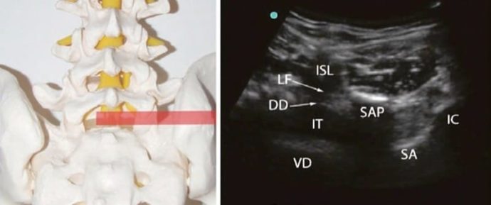 Ultrasound-Guided Lumbar Facet Nerve Block and Intra-articular ...