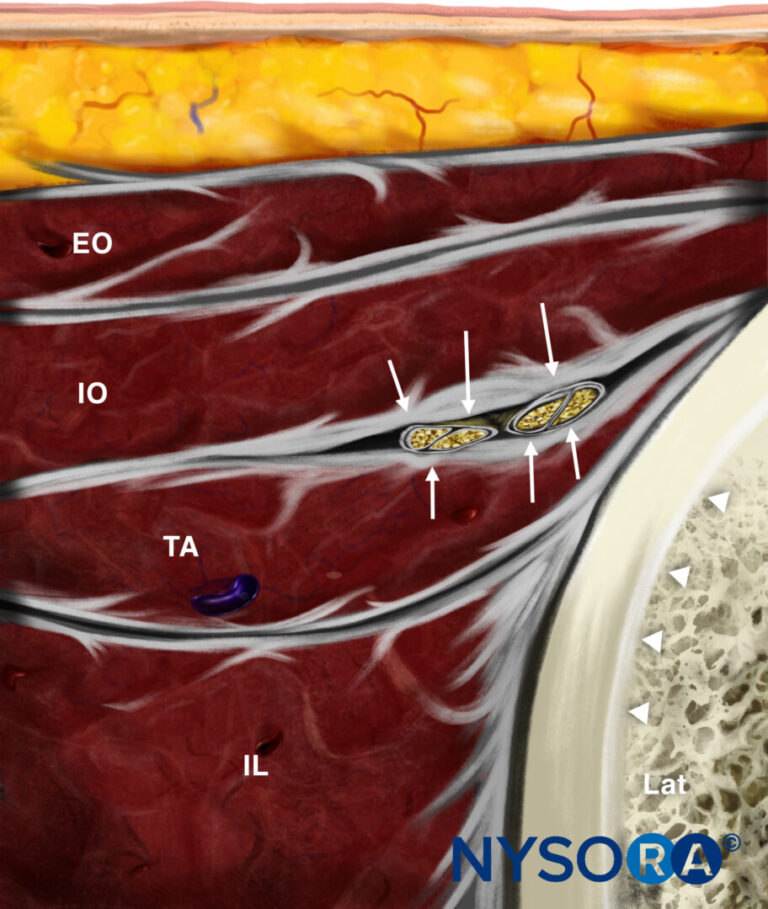 Ultrasound-Guided Blocks for Pelvic Pain - NYSORA