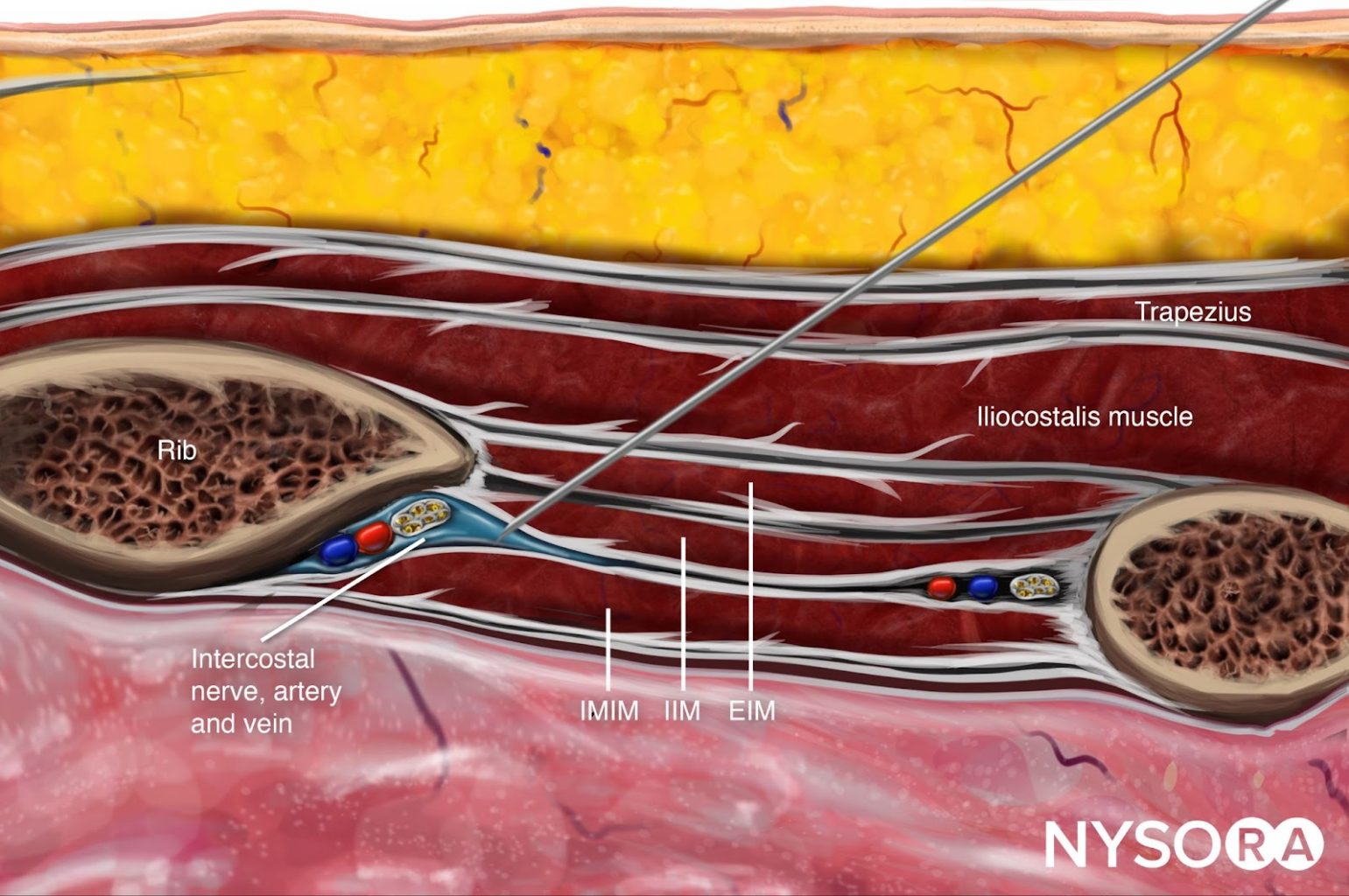 what-is-intercostal-neuralgiasymptomscausestreatmentp-vrogue-co