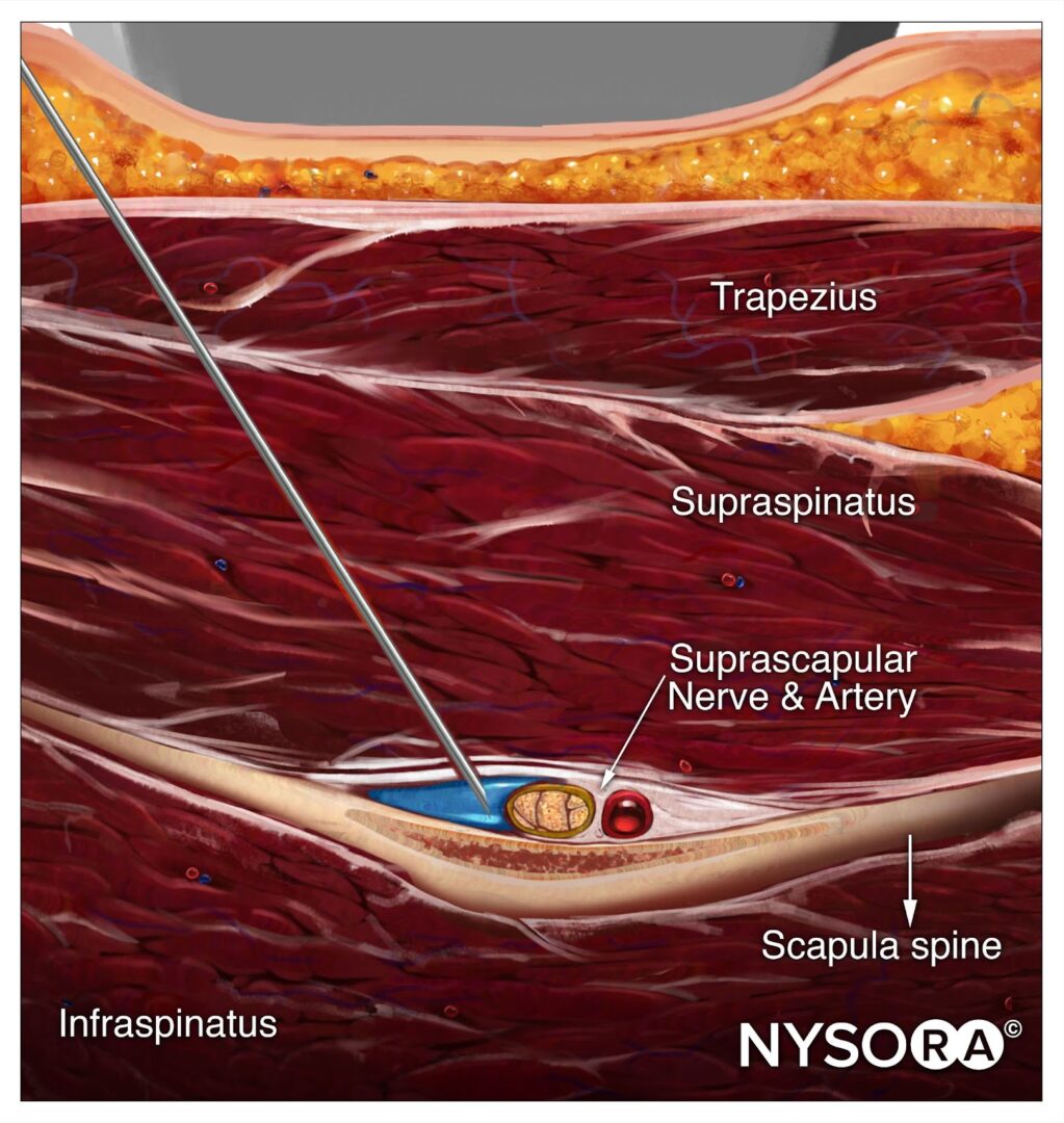 Ultrasound Pain Block Tip of the Week: Suprascapular Nerve Block - NYSORA