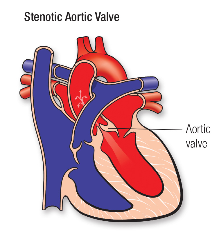 Aortic stenosis