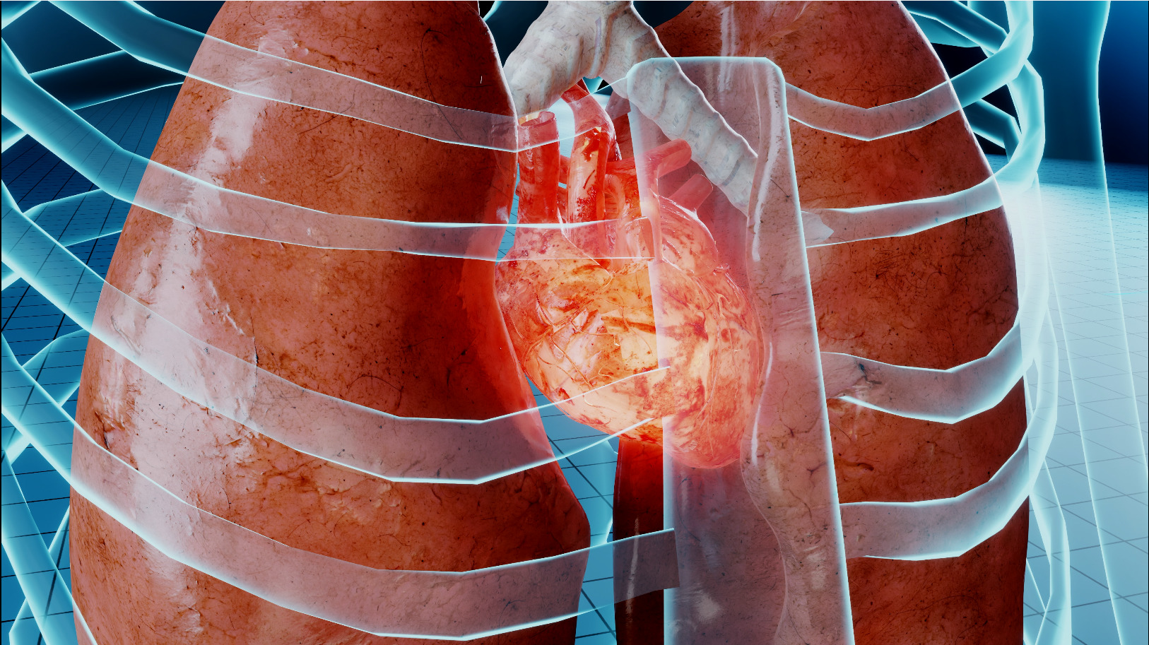 Cardiac contusion