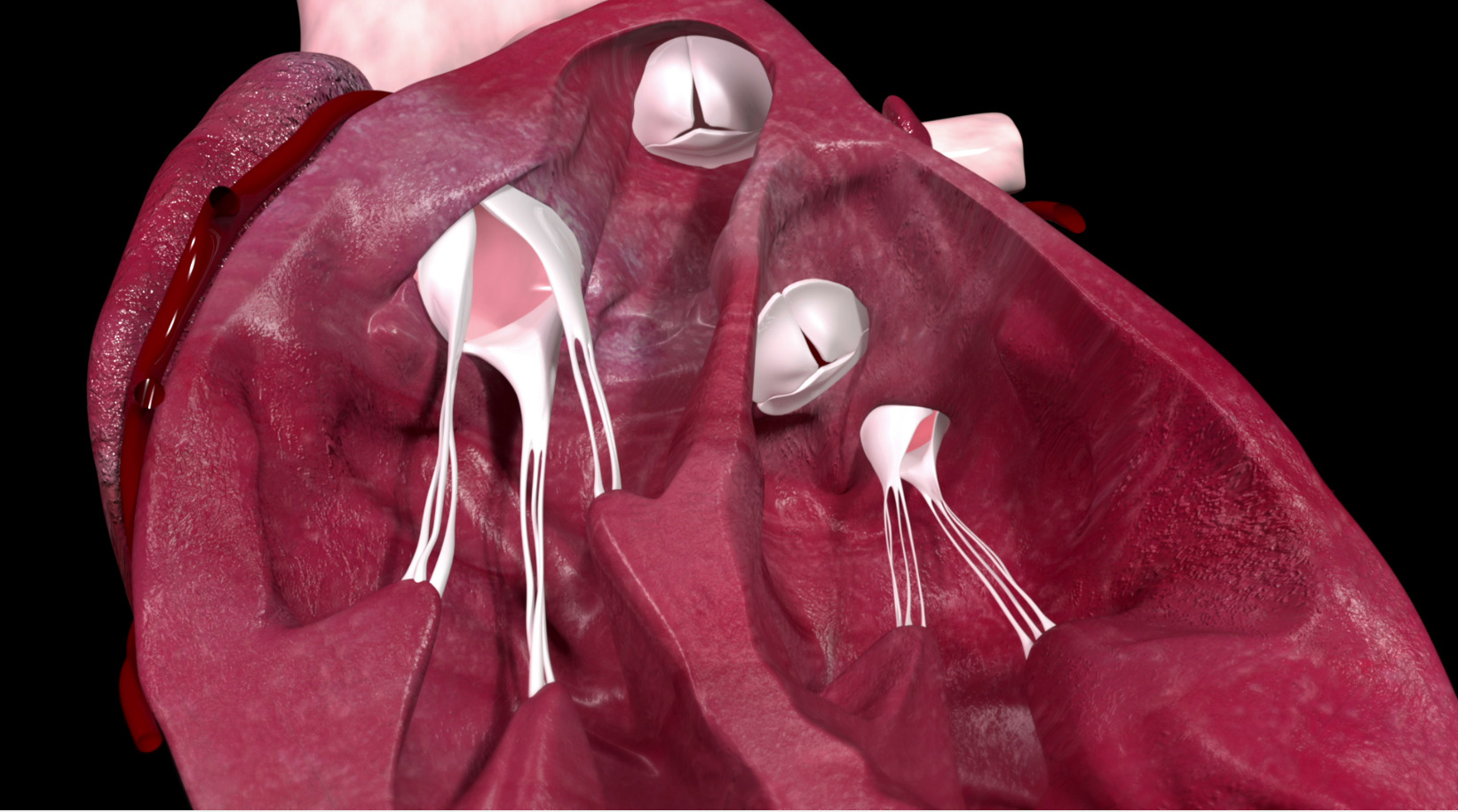 Mitral stenosis