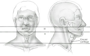 Penetrating Neck Injuries - NYSORA | NYSORA