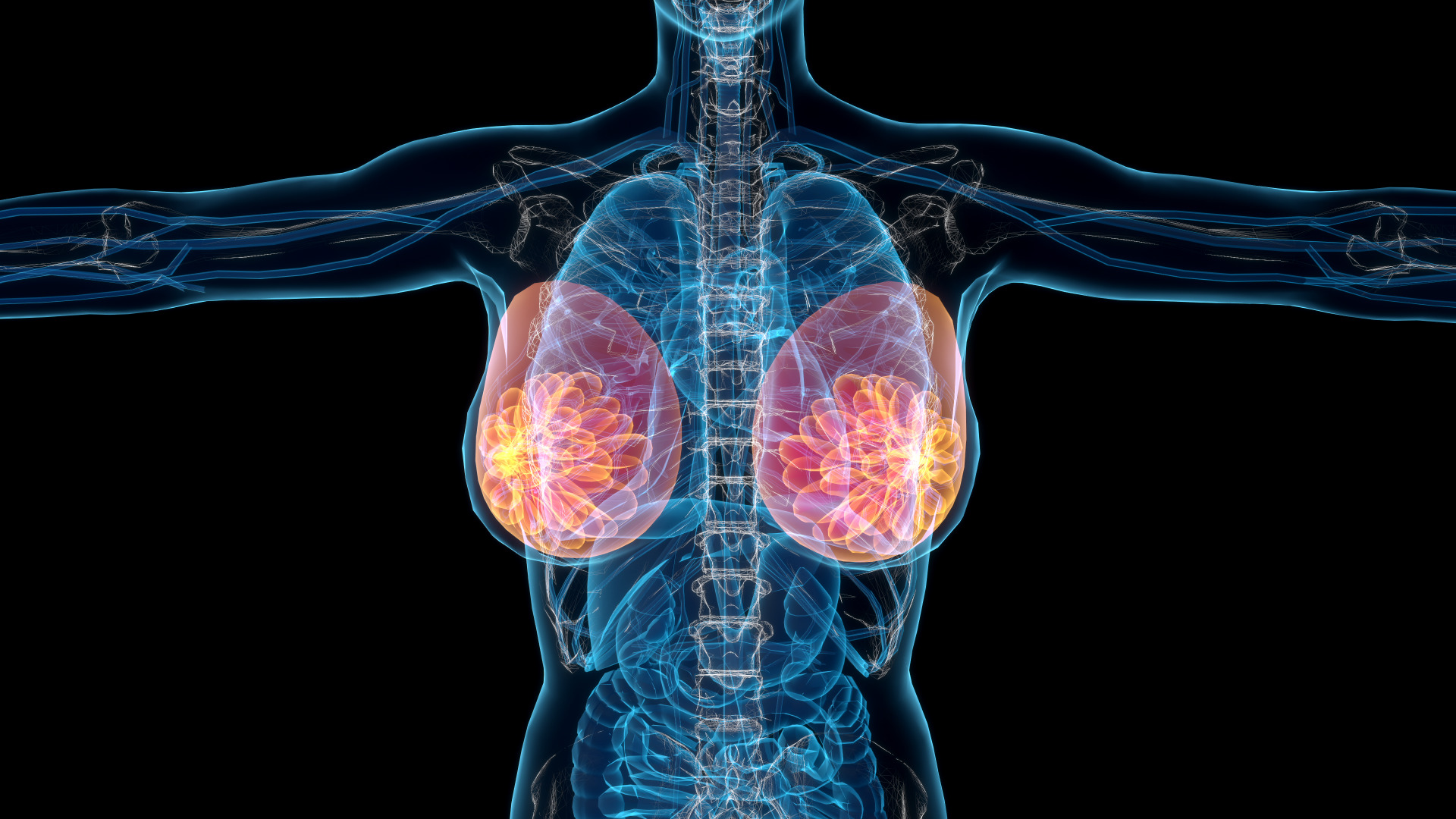 Anterior mediastinal mass