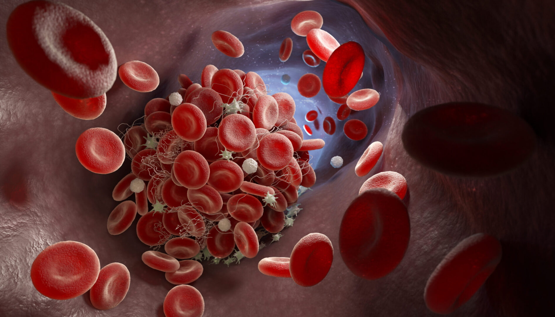 Antiphospholipid antibody syndrome