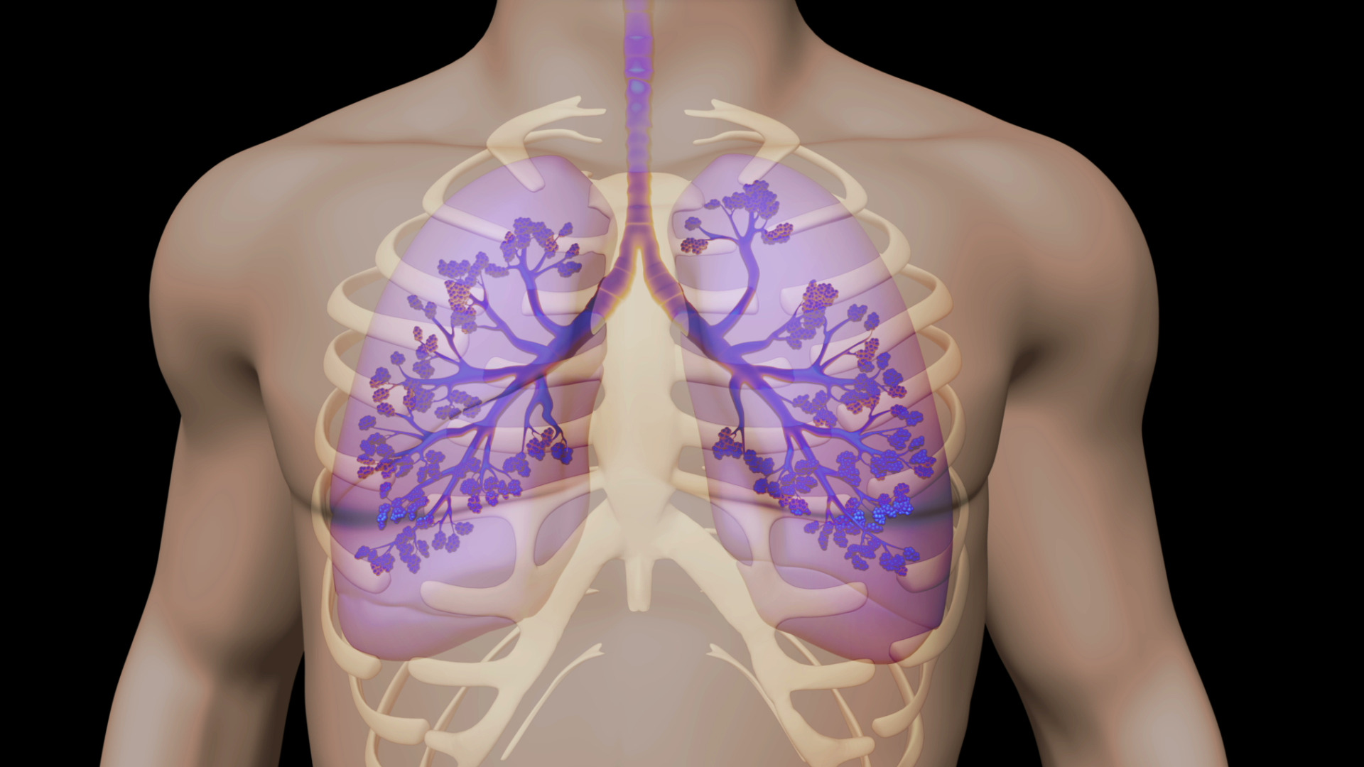 Bronchopleural fistula