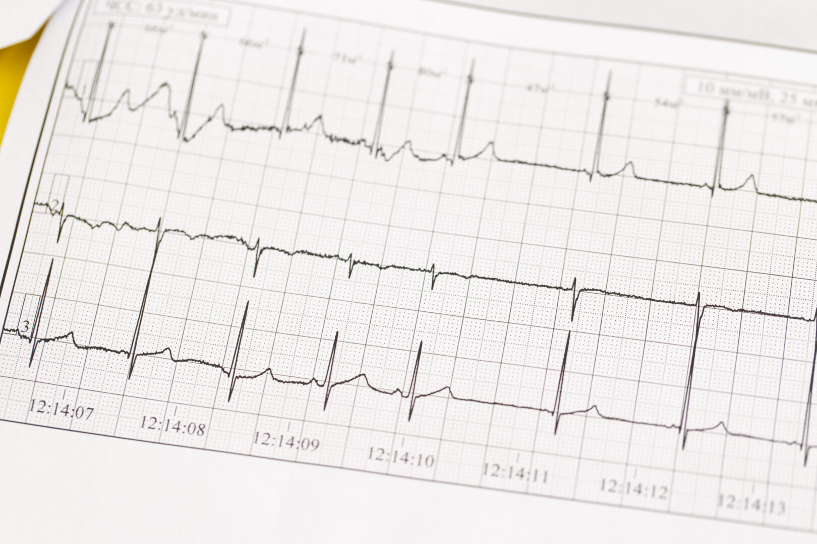 Hyperkalemia