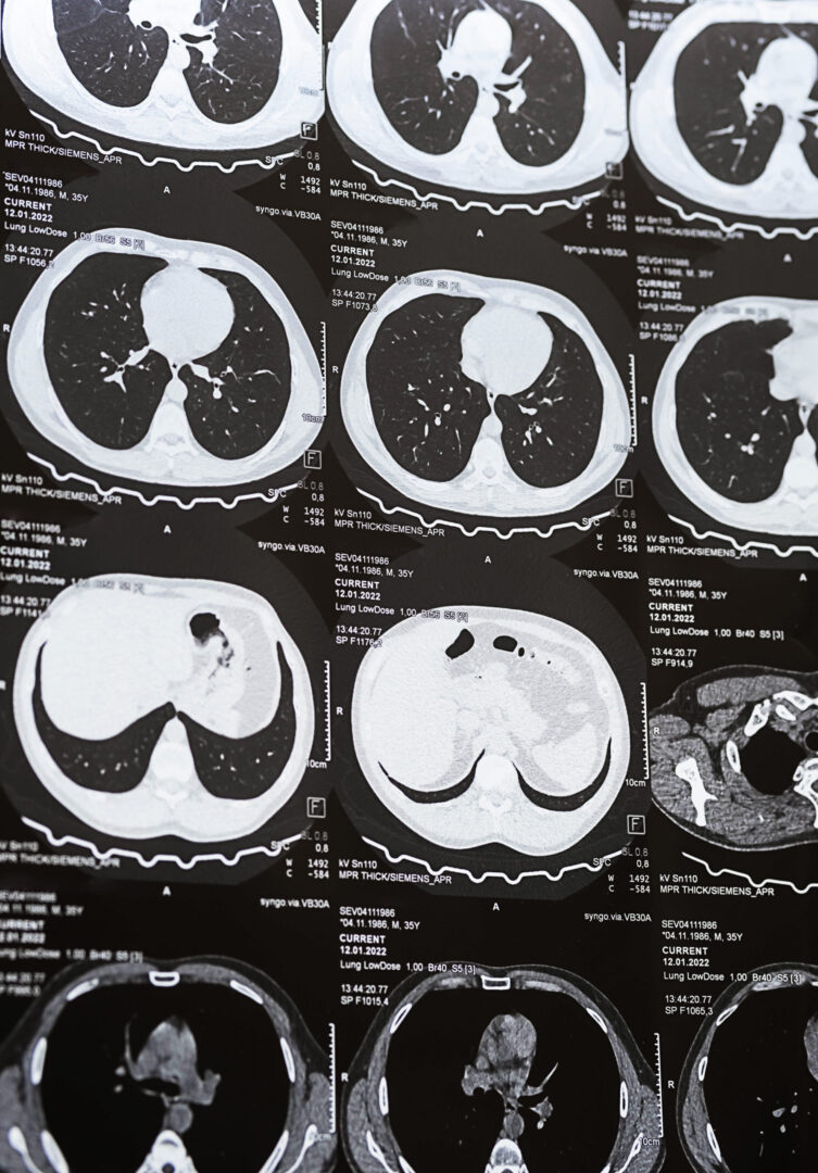 Mediastinoscopy