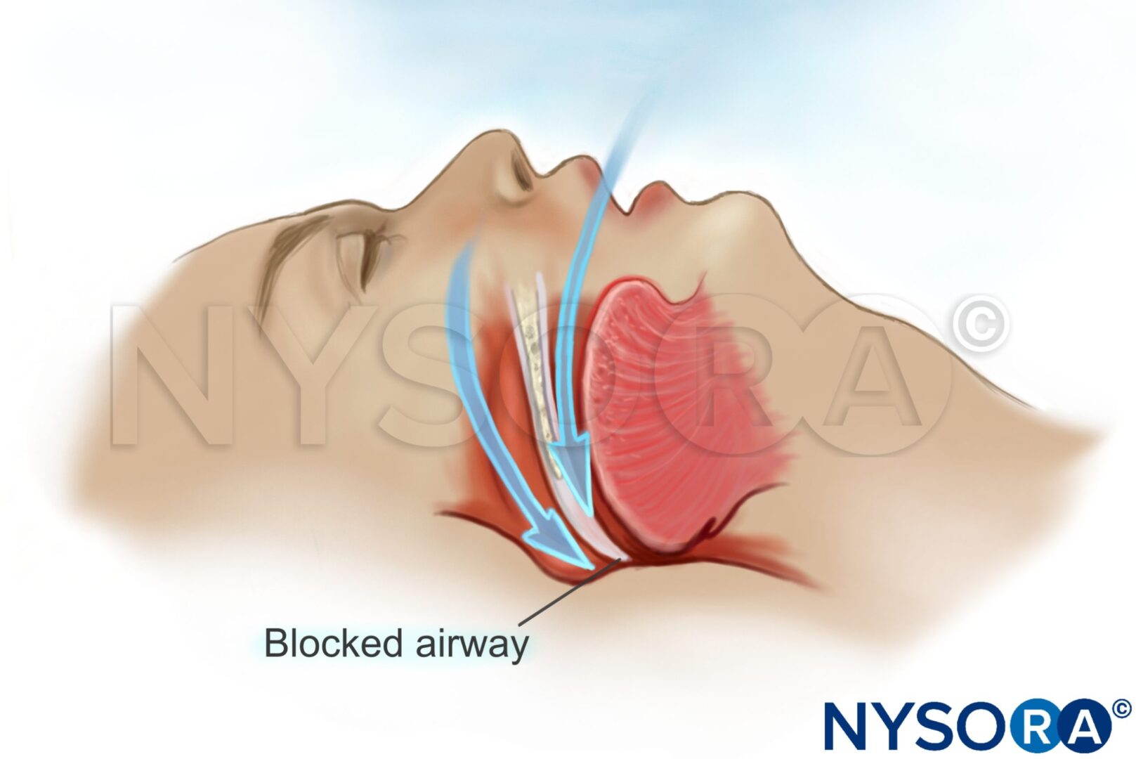 Obstructive sleep apnea