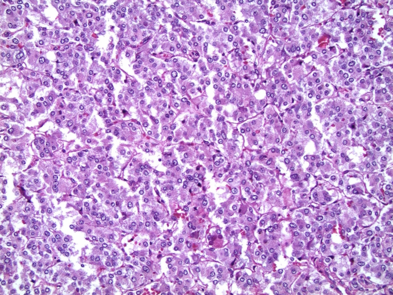 Pheochromocytoma