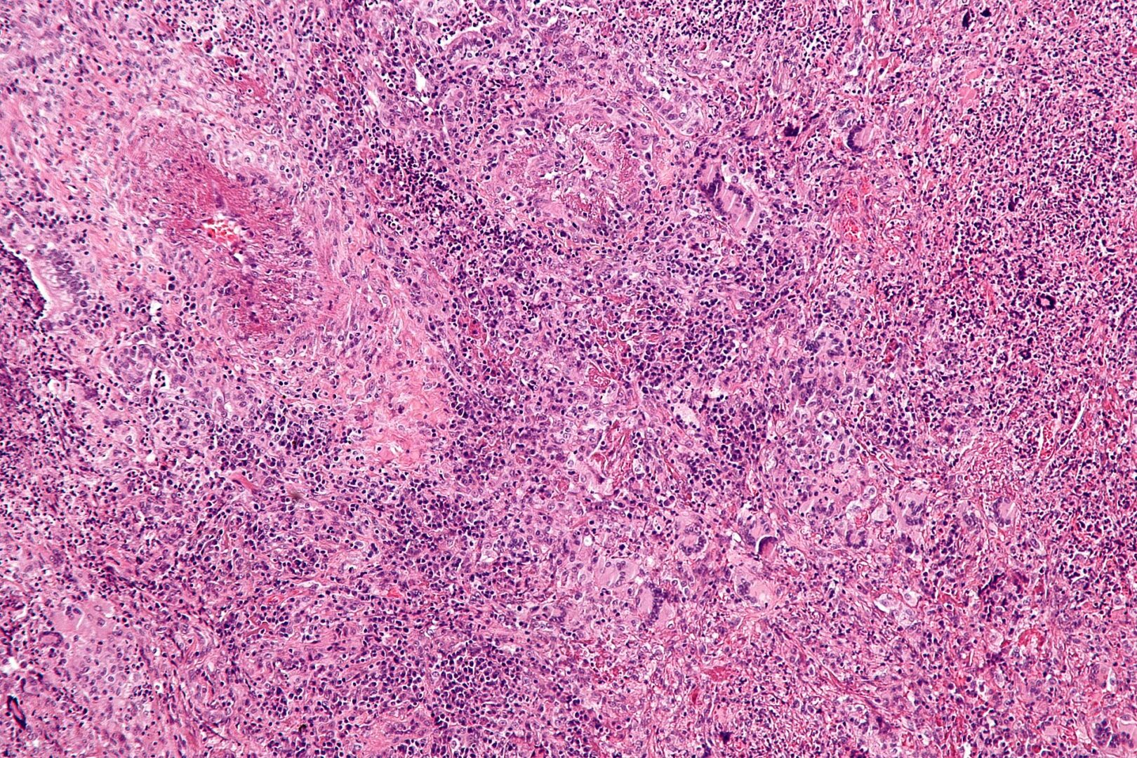 Wegener’s granulomatosis