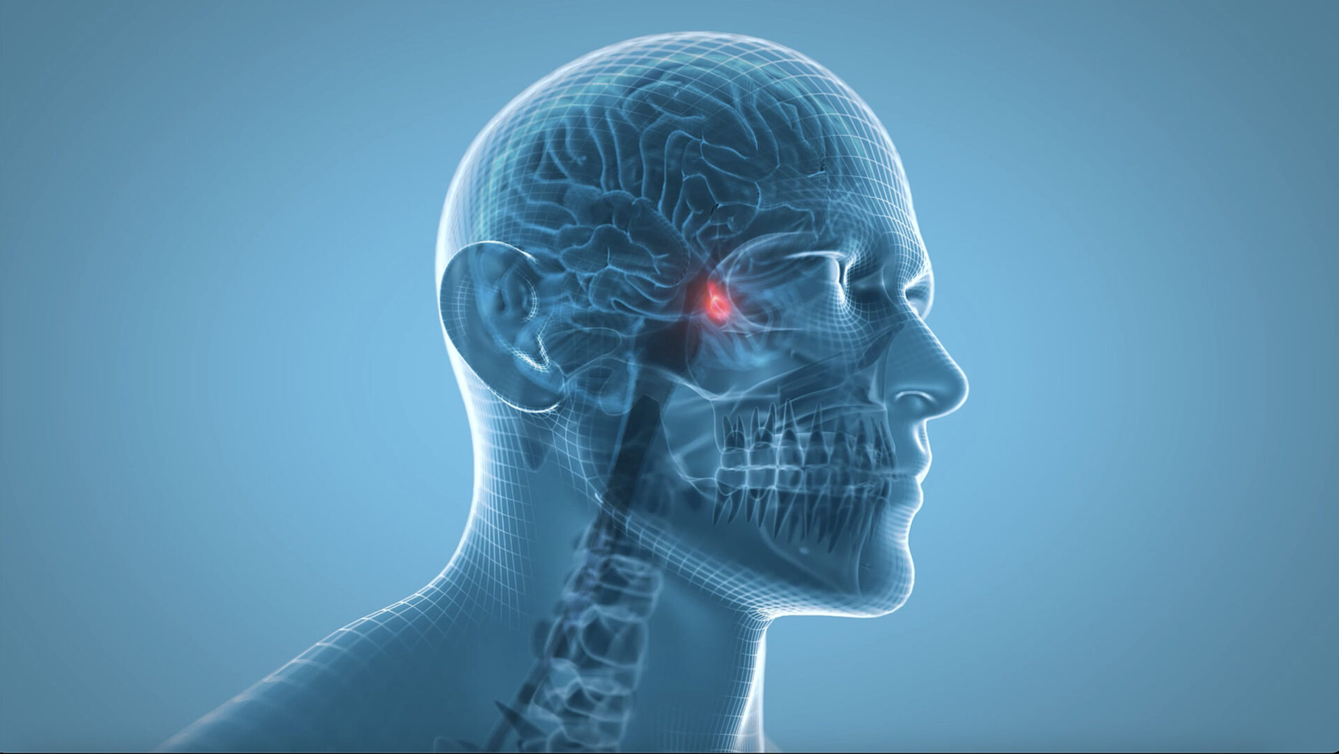 Acromegaly