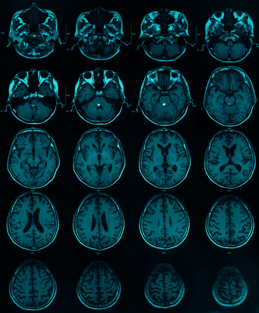 Subarachnoid hemorrhage