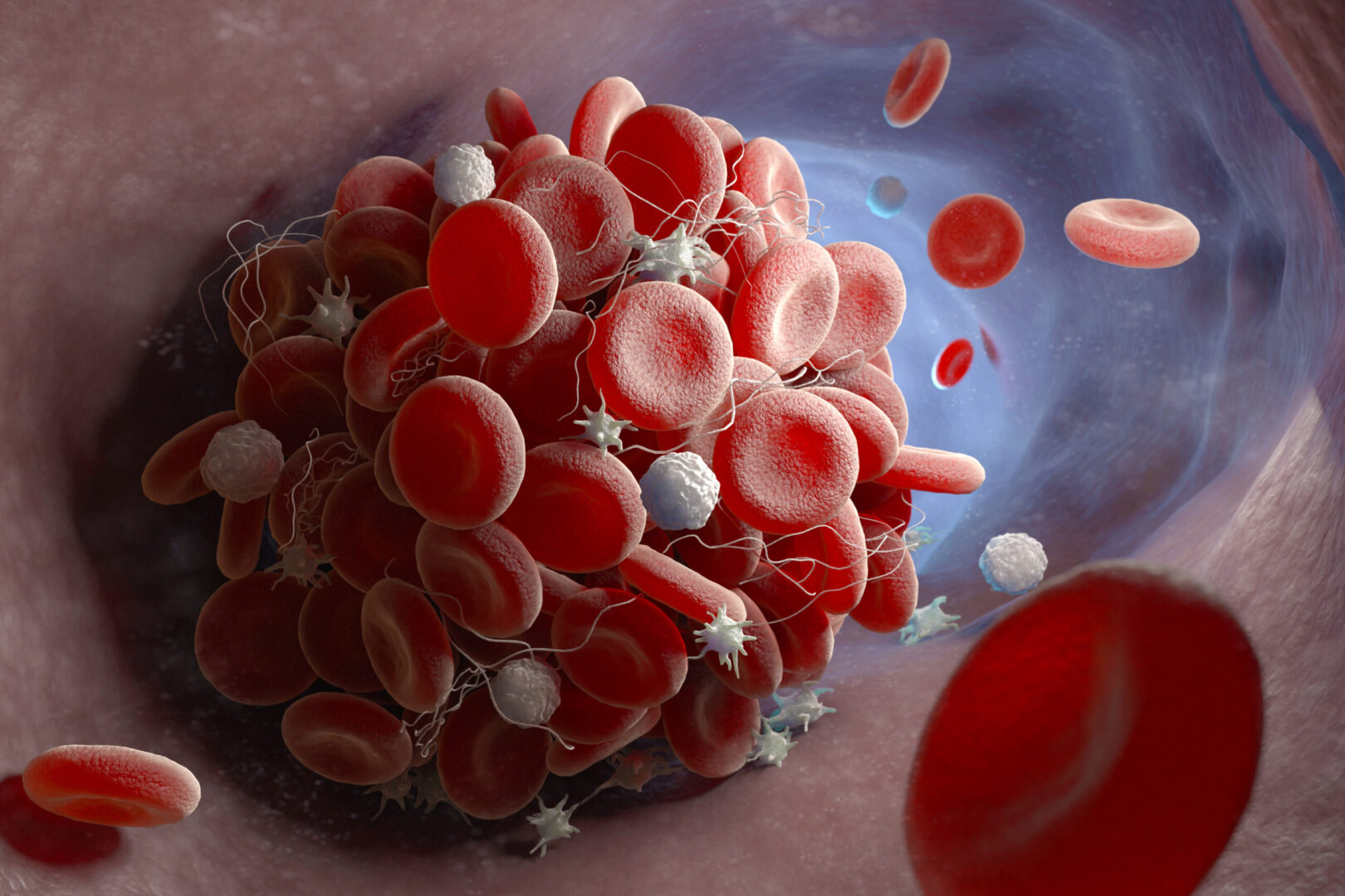 Venous thromboembolism