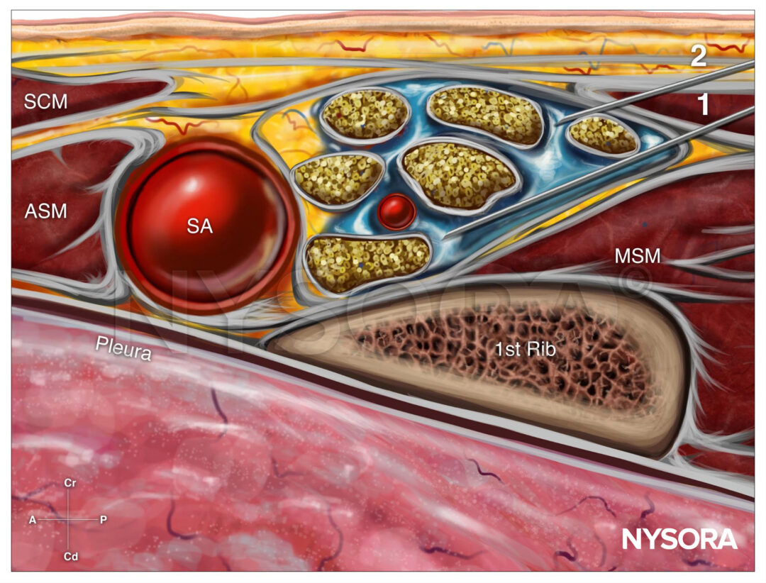 Tips for a Supraclavicular Brachial Plexus Block - NYSORA